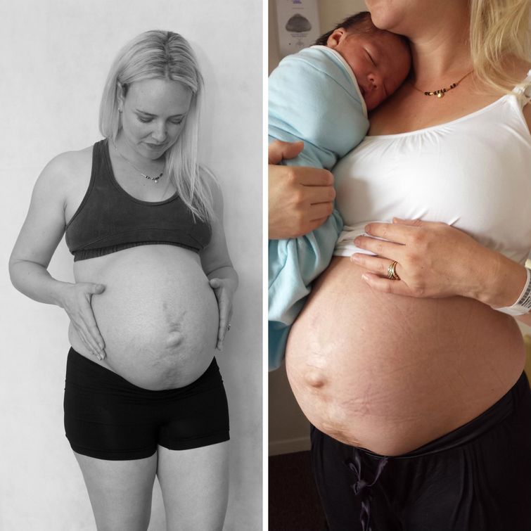 фото для записи Новоиспеченная мама показала как менялось её тело в течение 14 дней после родов